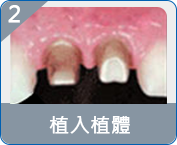 氹仔半口假牙費用