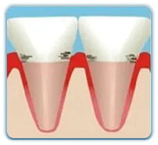 珠海牙周病治療多少錢
